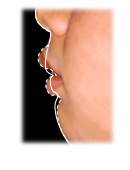 上顎前突横（出っ歯）ライン画像