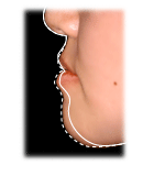 下顎前突、反対交合横（受け口）ライン画像